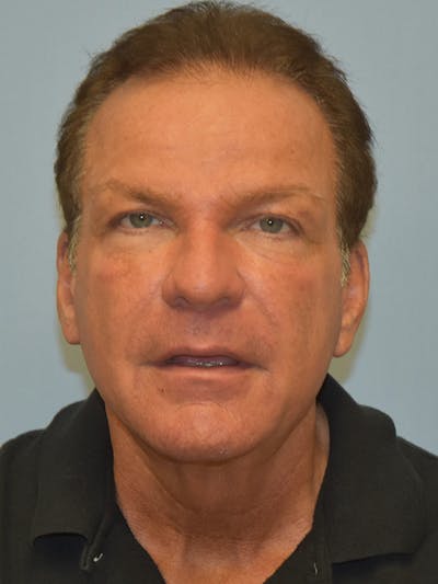 Facelift Before & After Gallery - Patient 102518 - Image 1