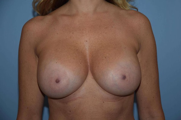Breast Augmentation Before & After Gallery - Patient 929415 - Image 2