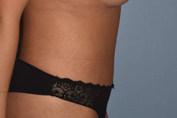 Tummy Tuck Before & After Gallery - Patient 204149 - Image 4