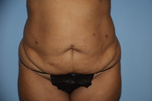 Before and After Abdominoplasty in Long Island