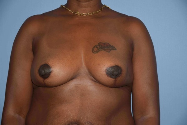 Breast Reduction Before & After Gallery - Patient 387527 - Image 2