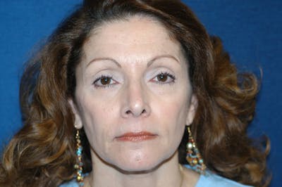 Facelift Before & After Gallery - Patient 332028 - Image 1