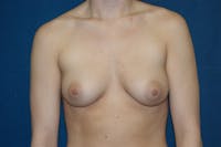 Breast Augmentation Before & After Gallery - Patient 209017 - Image 1