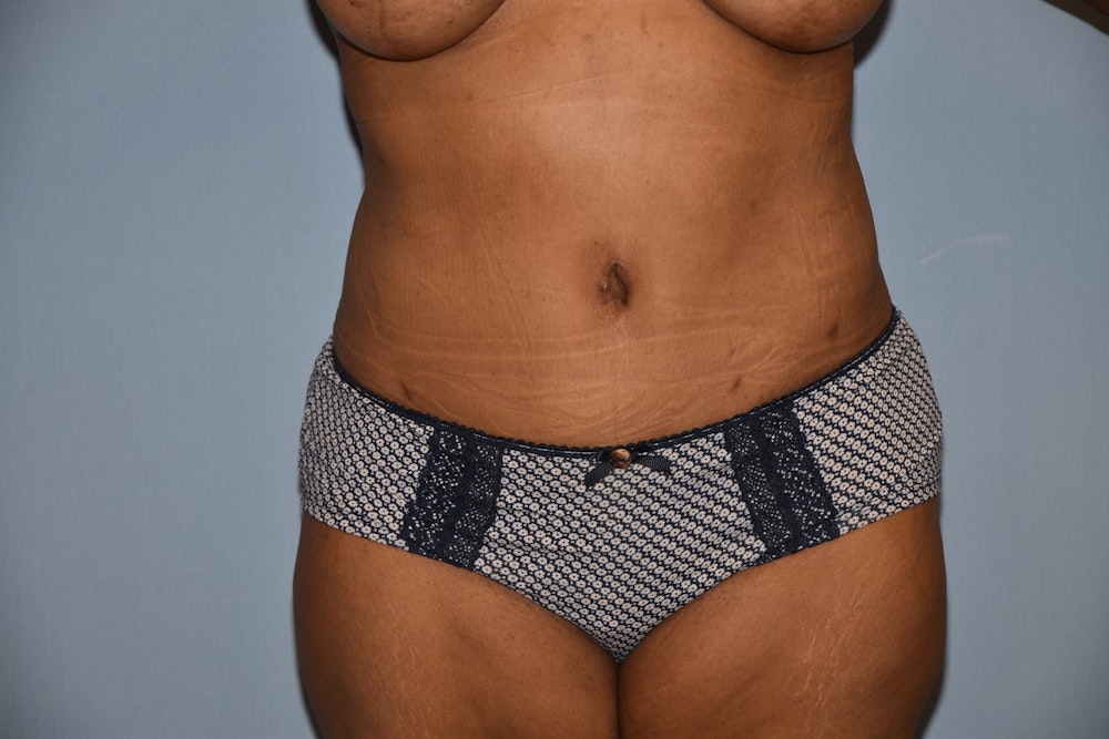 Before and After Abdominoplasty in Long Island