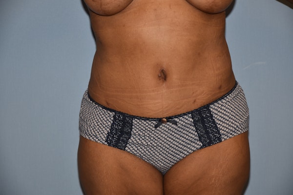 Tummy Tuck Before & After Gallery - Patient 142657 - Image 2