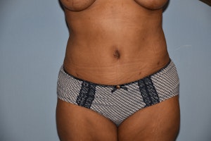 Before and After Abdominoplasty in Long Island