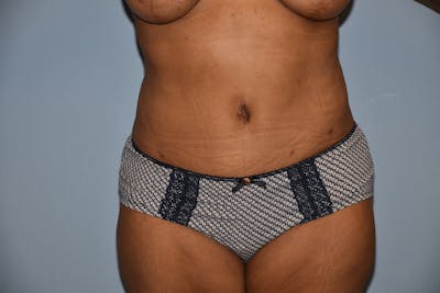 Tummy Tuck Before & After Gallery - Patient 142657 - Image 2