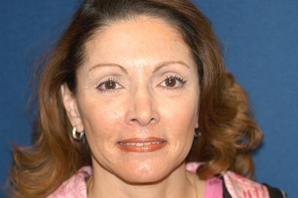 Facelift Before & After Gallery - Patient 332028 - Image 2