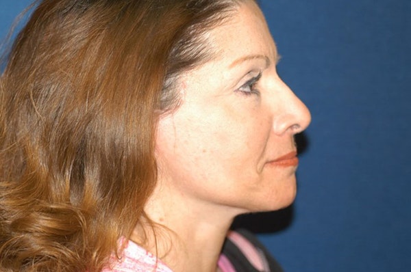 Facelift Before & After Gallery - Patient 332028 - Image 4