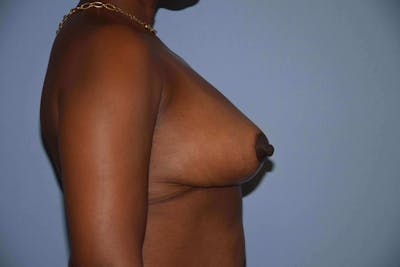 Breast Reduction Before & After Gallery - Patient 387527 - Image 6
