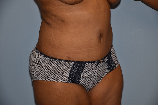Tummy Tuck Before & After Gallery - Patient 142657 - Image 4