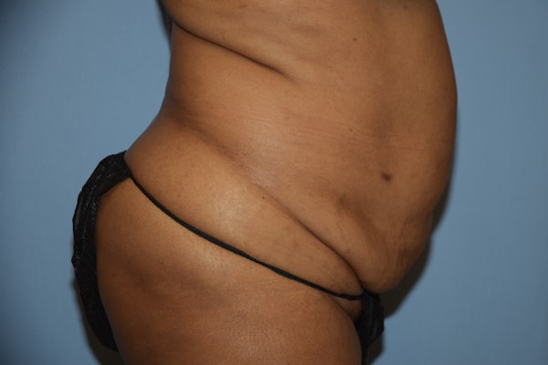 Tummy Tuck Before & After Gallery - Patient 142657 - Image 5