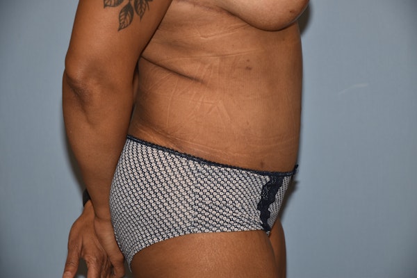 Tummy Tuck Before & After Gallery - Patient 142657 - Image 6