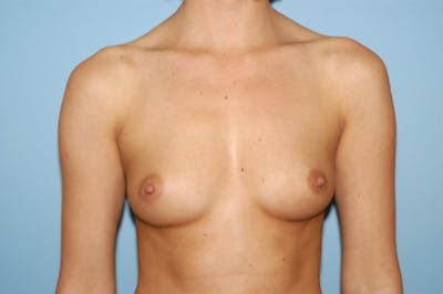 Breast Augmentation Before & After Gallery - Patient 202740 - Image 1