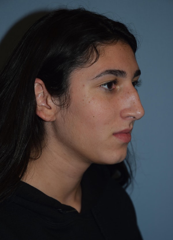 Rhinoplasty Before & After Gallery - Patient 283566 - Image 5
