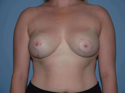 Breast Reduction Before & After Gallery - Patient 403438 - Image 2