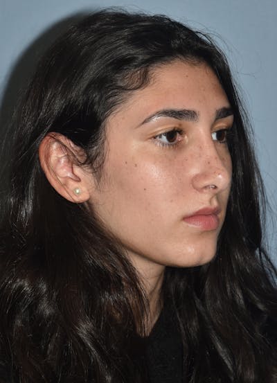 Rhinoplasty Before & After Gallery - Patient 283566 - Image 6