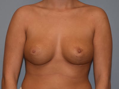 Breast Reduction Before & After Gallery - Patient 108804 - Image 2