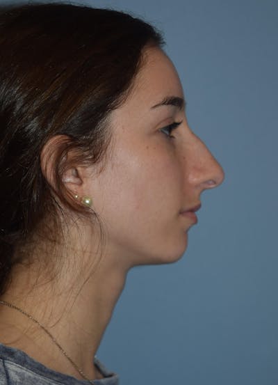 Rhinoplasty Before & After Gallery - Patient 220837 - Image 1