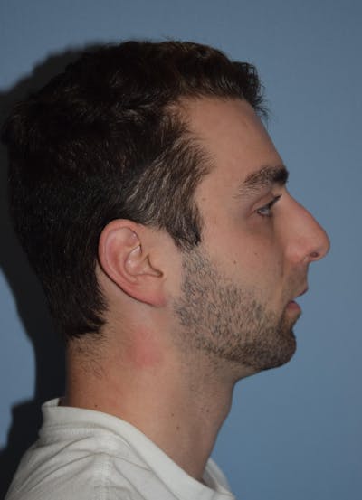 Rhinoplasty Before & After Gallery - Patient 877050 - Image 1