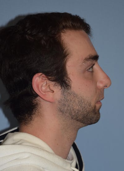 Rhinoplasty Before & After Gallery - Patient 877050 - Image 2