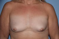 Breast Augmentation Before & After Gallery - Patient 355509 - Image 1