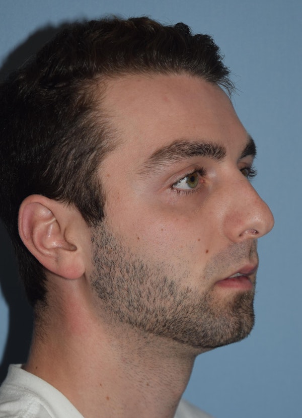 Rhinoplasty Before & After Gallery - Patient 877050 - Image 5