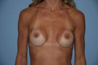 Breast Augmentation Before & After Gallery - Patient 373382 - Image 1