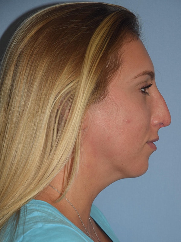 Rhinoplasty Before & After Gallery - Patient 137622 - Image 1