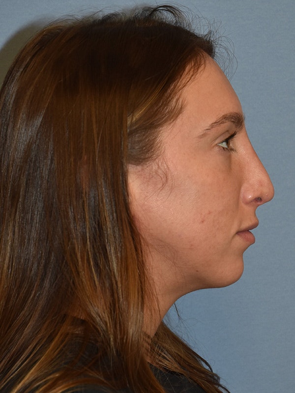 Rhinoplasty Before & After Gallery - Patient 137622 - Image 2