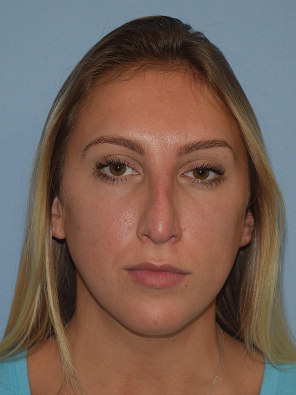 Rhinoplasty Before & After Gallery - Patient 137622 - Image 3