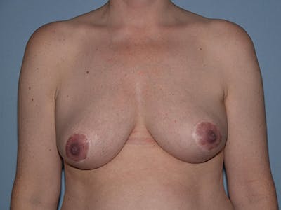 Breast Reduction Before & After Gallery - Patient 141459 - Image 2