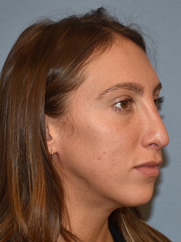 Rhinoplasty Before & After Gallery - Patient 137622 - Image 6