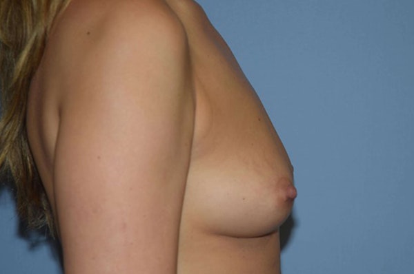 Breast Augmentation Before & After Gallery - Patient 722036 - Image 5