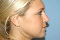 Rhinoplasty Before & After Gallery - Patient 327437 - Image 1