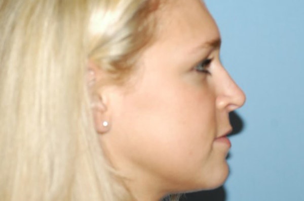 Rhinoplasty Before & After Gallery - Patient 327437 - Image 2