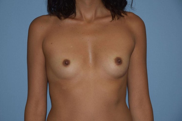 Breast Augmentation Before & After Gallery - Patient 180865 - Image 1
