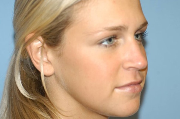 Rhinoplasty Before & After Gallery - Patient 327437 - Image 5