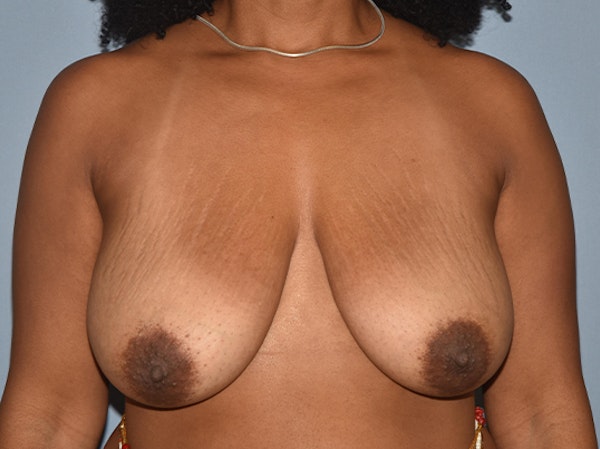 Breast Reduction Before & After Gallery - Patient 315962 - Image 1