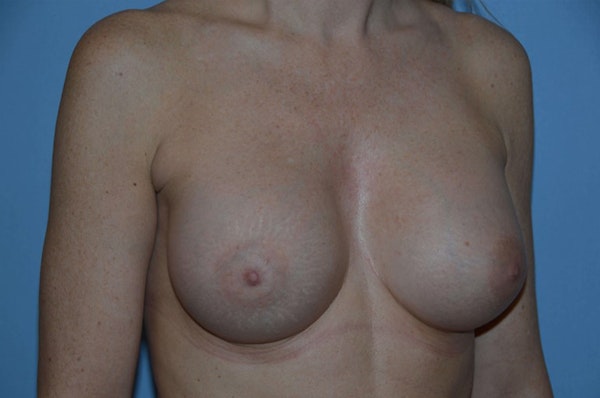 Breast Augmentation Before & After Gallery - Patient 219877 - Image 4