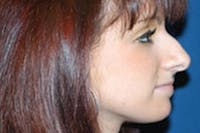 Rhinoplasty Before & After Gallery - Patient 163026 - Image 1