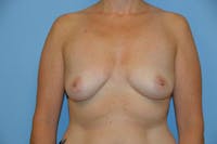 Breast Augmentation Before & After Gallery - Patient 305939 - Image 1