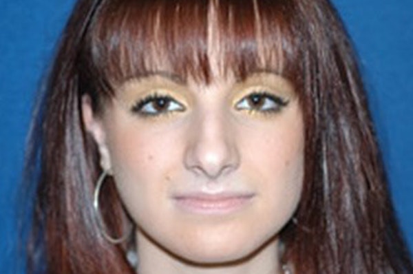 Rhinoplasty Before & After Gallery - Patient 163026 - Image 3