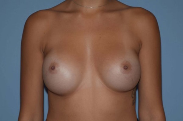 Breast Augmentation Before & After Gallery - Patient 217120 - Image 2