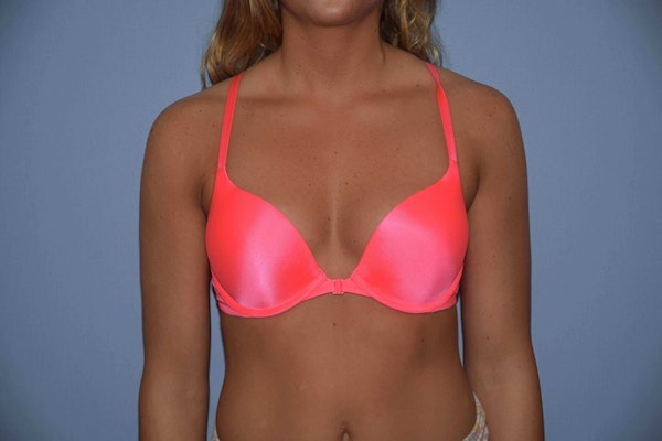Breast Augmentation Before & After Gallery - Patient 102482 - Image 7