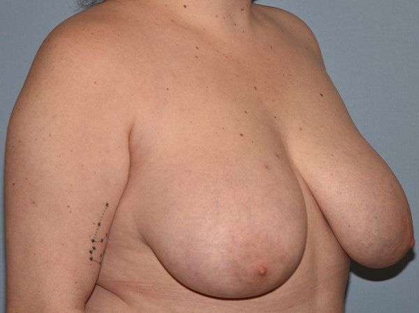 Breast Reduction Before & After Gallery - Patient 283464 - Image 3