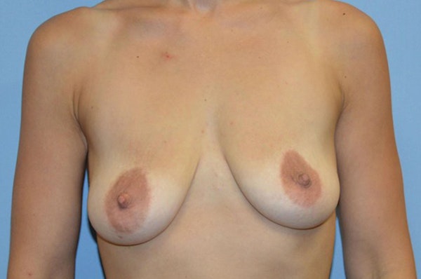 Breast Augmentation Lift Before & After Gallery - Patient 121709 - Image 1