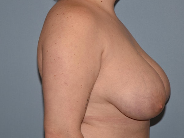 Breast Reduction Before & After Gallery - Patient 283464 - Image 5