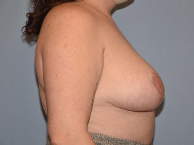 Breast Reduction Before & After Gallery - Patient 283464 - Image 6