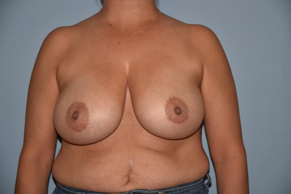 Breast Reduction Before & After Gallery - Patient 269229 - Image 1